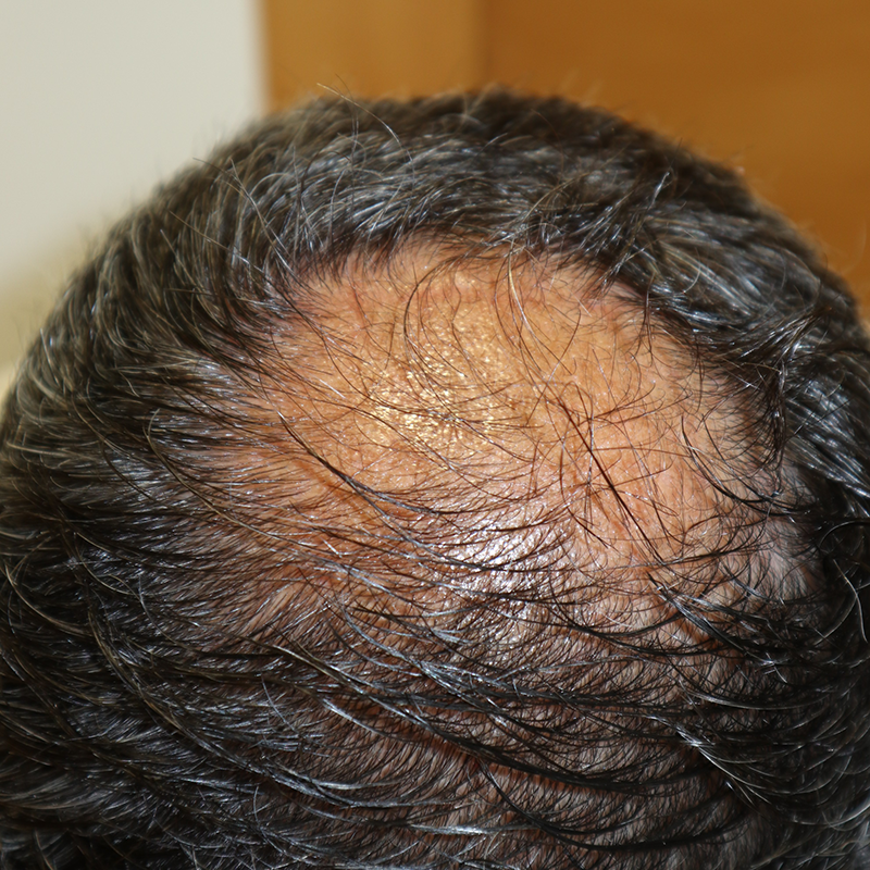 Algoritmo de tratamiento MAGA (Alopecia androgenética masculina) - DerMar Dermatológica