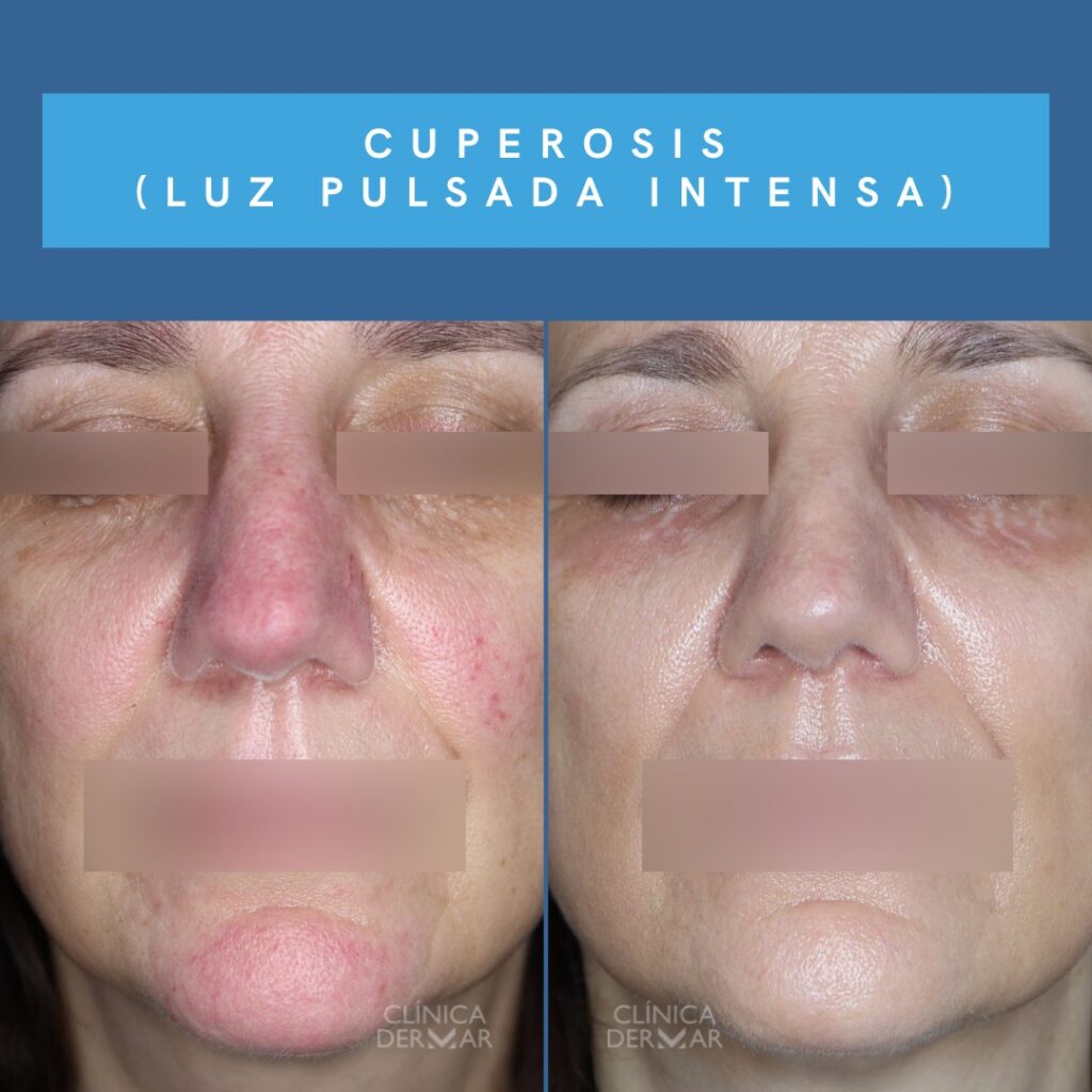 Tratamiento Cuperosis - Dermatólogo en Valencia | Clínica Dermar