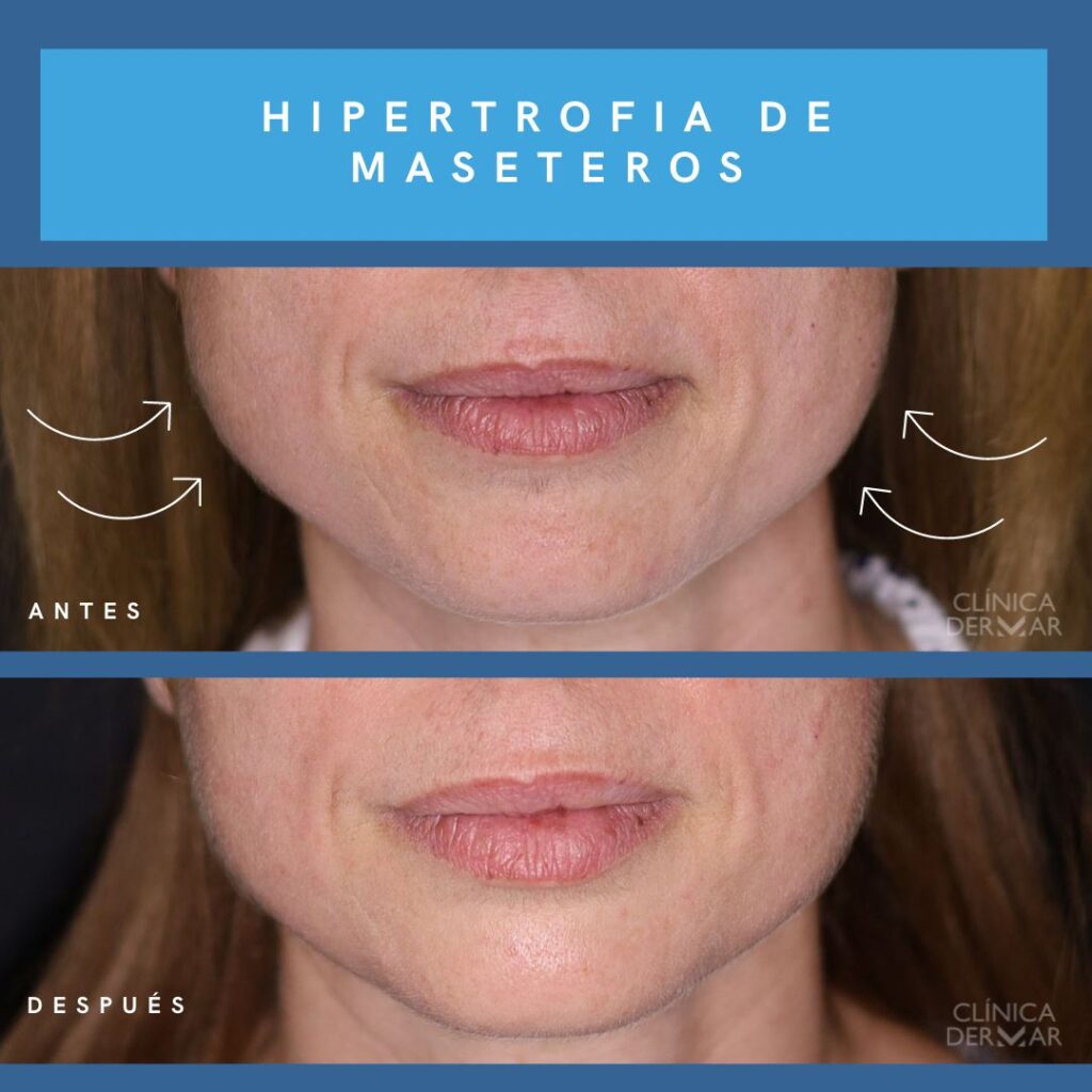 Hipertrofia de maseteros - Dermatólogo en Valencia | Clínica Dermar