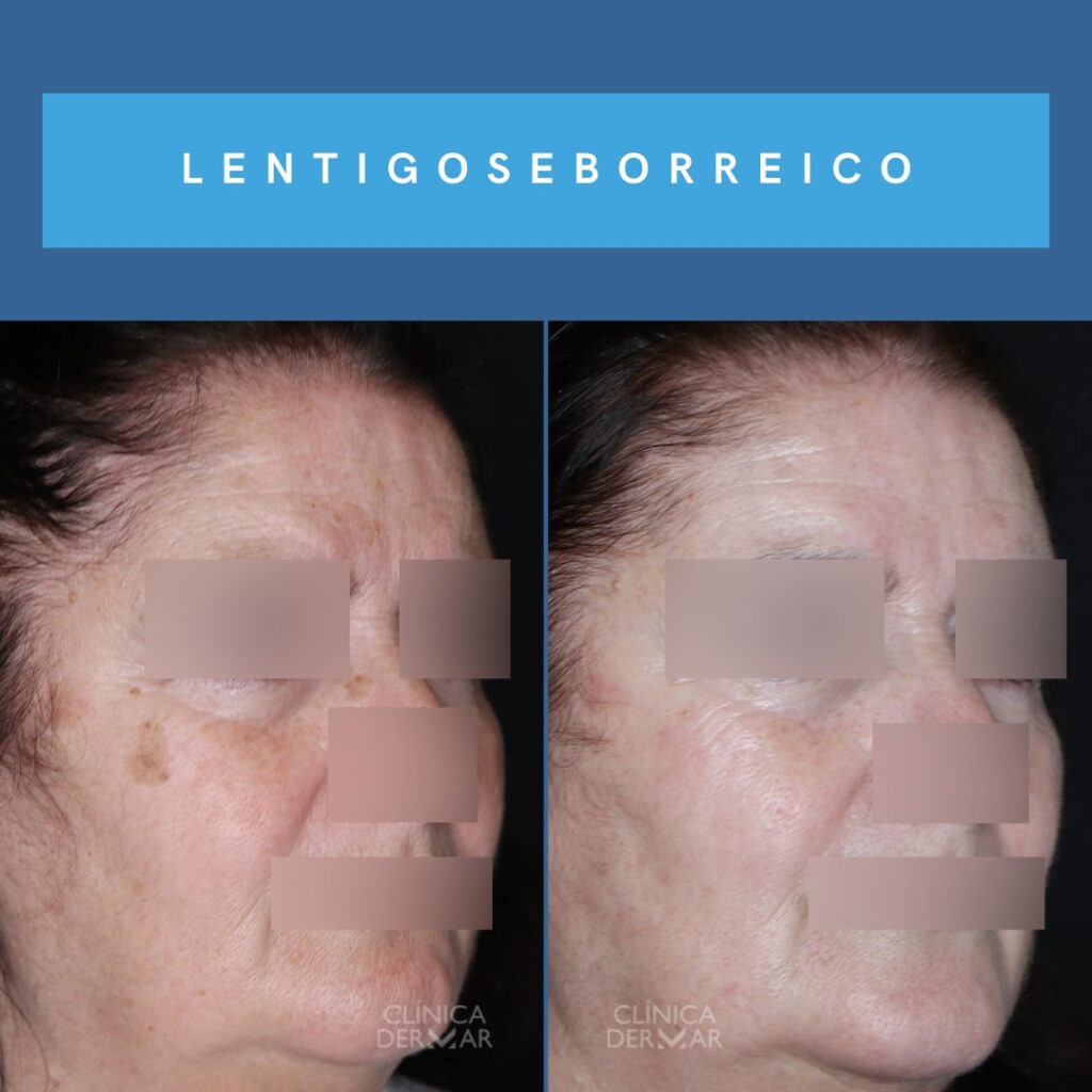 Eliminación de Manchas en la Piel - Dermatólogo en Valencia | Clínica Dermar