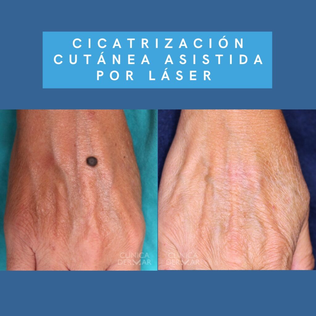 Cicatrización Cutánea Asistida por Láser - Dermatólogo en Valencia | Clínica Dermar