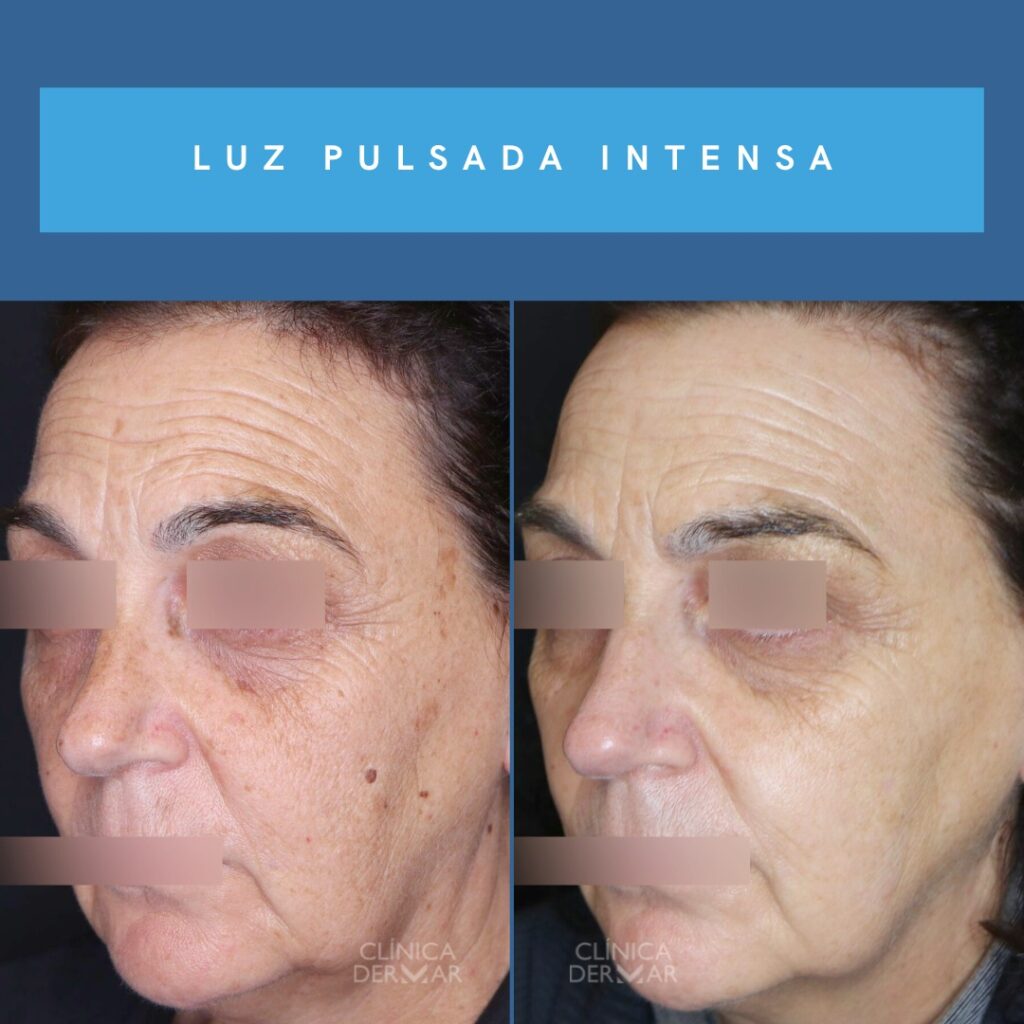 Tratamiento de Luz Pulsada Intensa - Dermatólogo en Valencia | Clínica Dermar