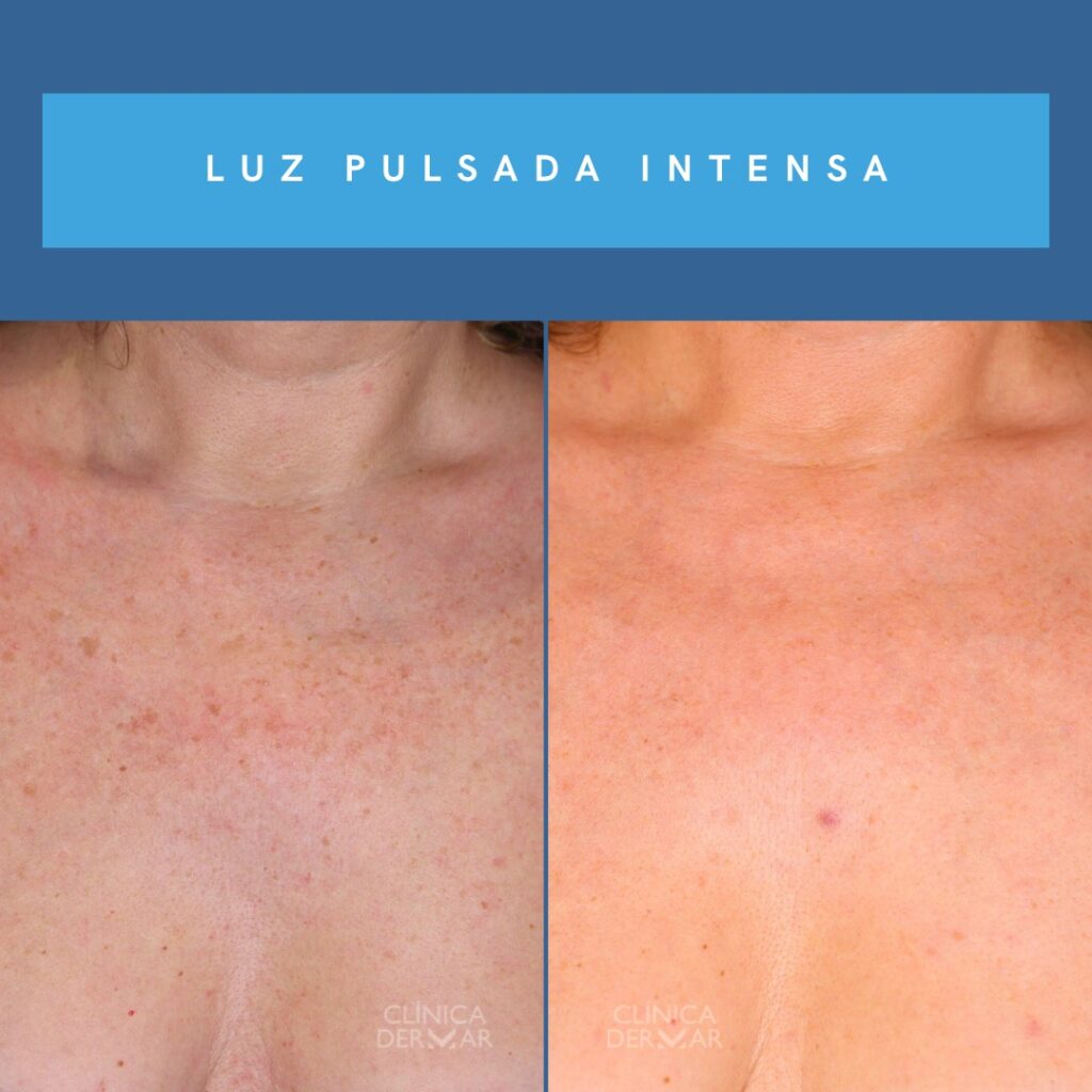 Tratamiento de Luz Pulsada Intensa - Dermatólogo en Valencia | Clínica Dermar