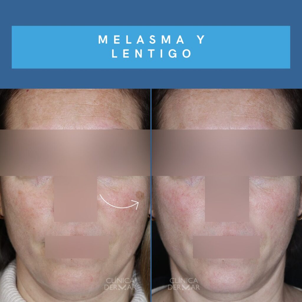 Dermatólogo Especialista en Melasma - Clínica Dermatológica en Valencia | Clínica Dermar