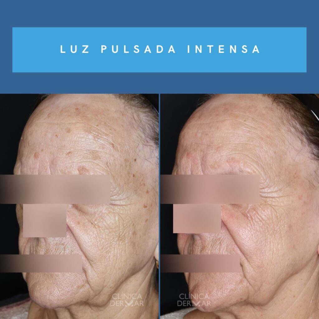 Tratamiento de Luz Pulsada Intensa - Clínica Dermatológica en Valencia | Clínica Dermar